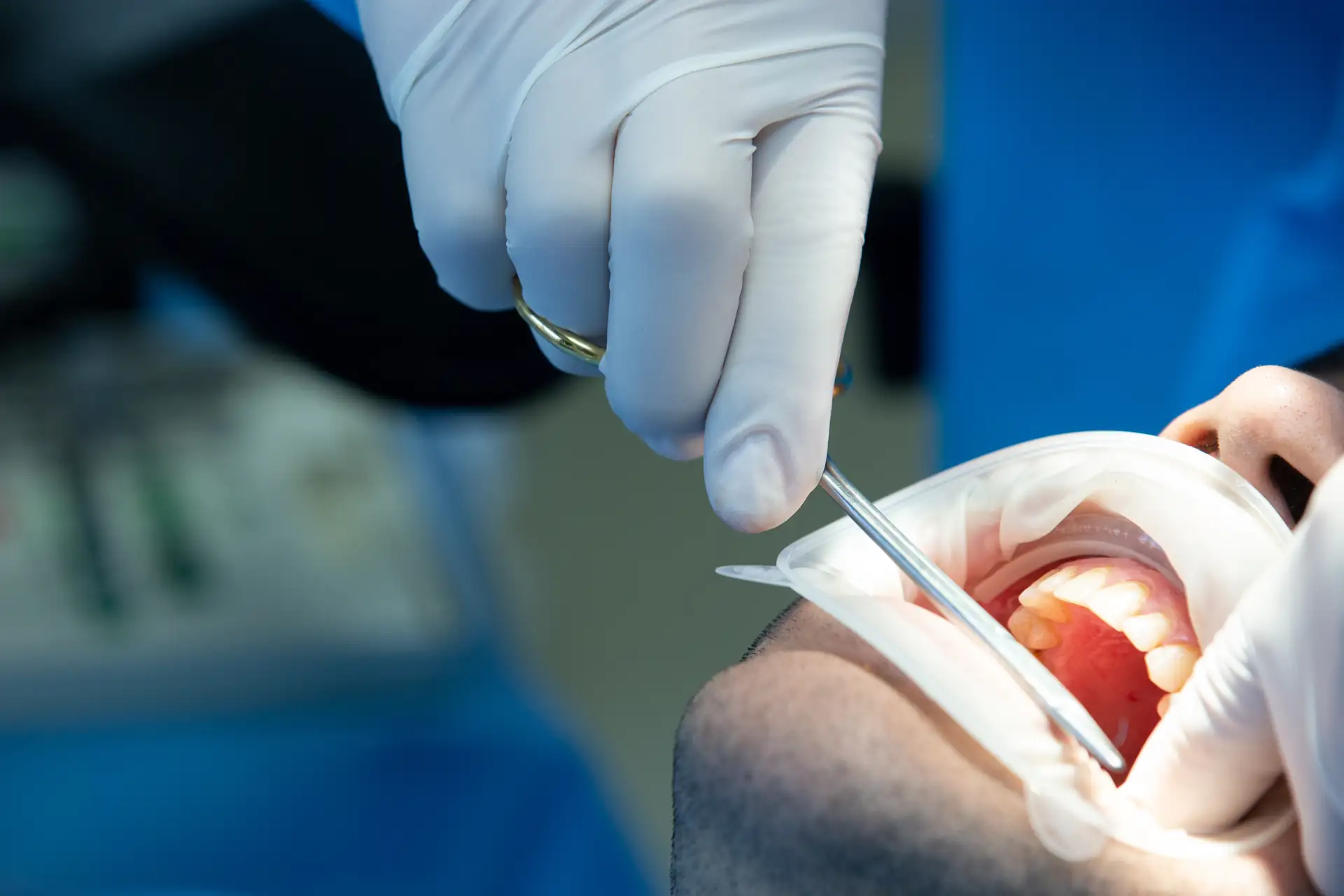 Cirurgia Periodontal