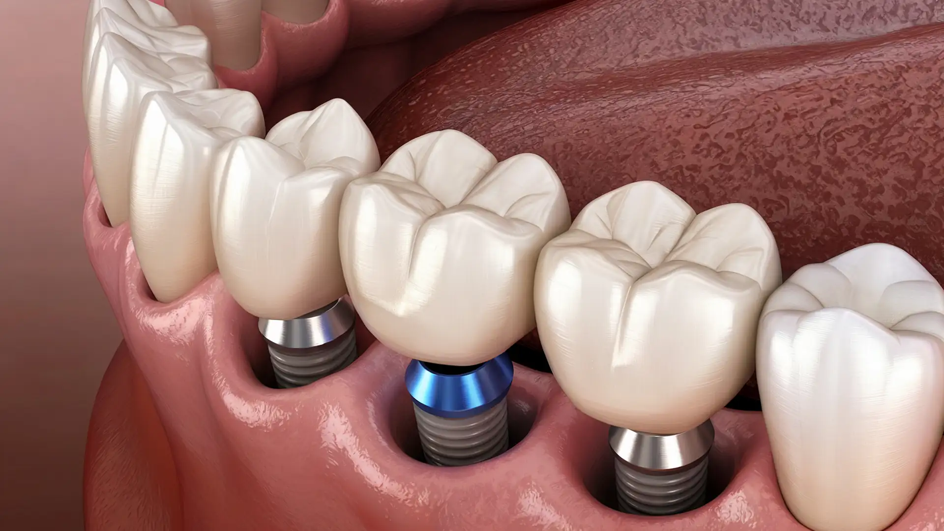 Implantes Múltiplos