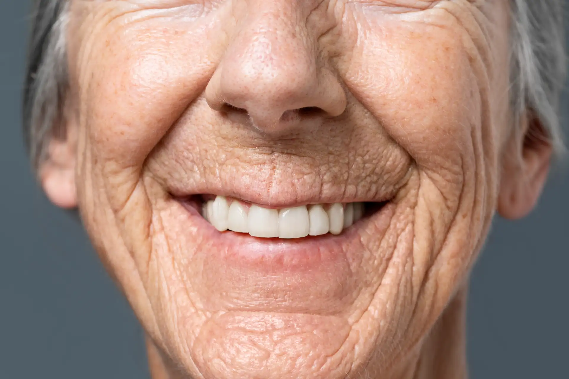 Overdenture e Carga Imediata