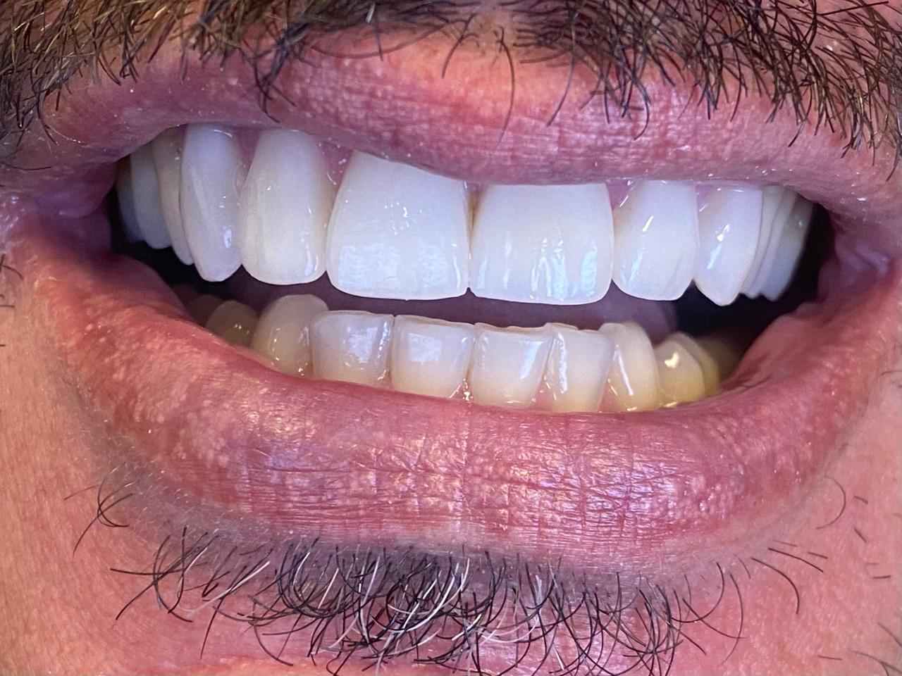 Facetas em Resina Composta