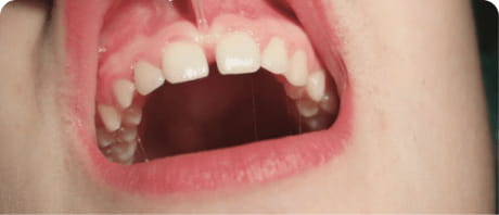 Cirurgia de Frenectomia