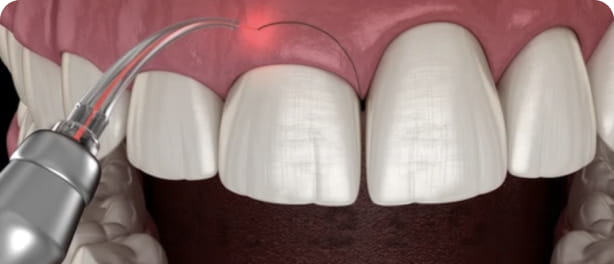 Cirurgias Periodontais (Gengiva e Tecido de Suporte)