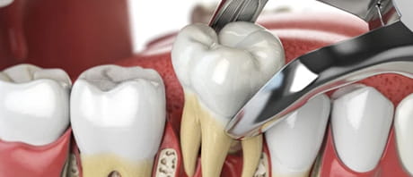 Extração Dentária Simples e Complexa